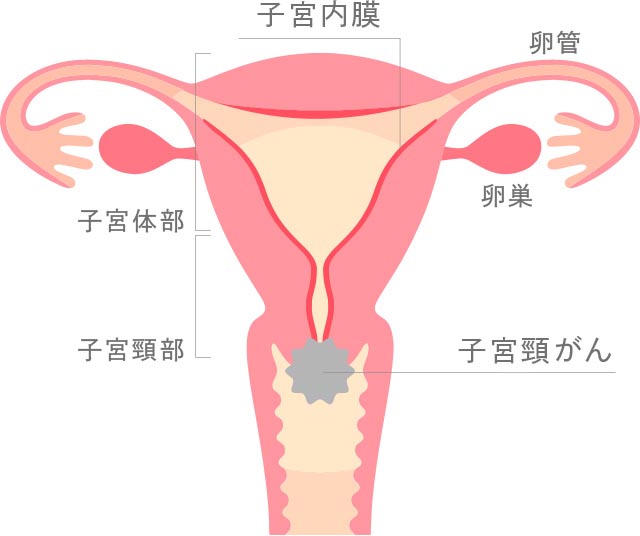 子宮頸がん
