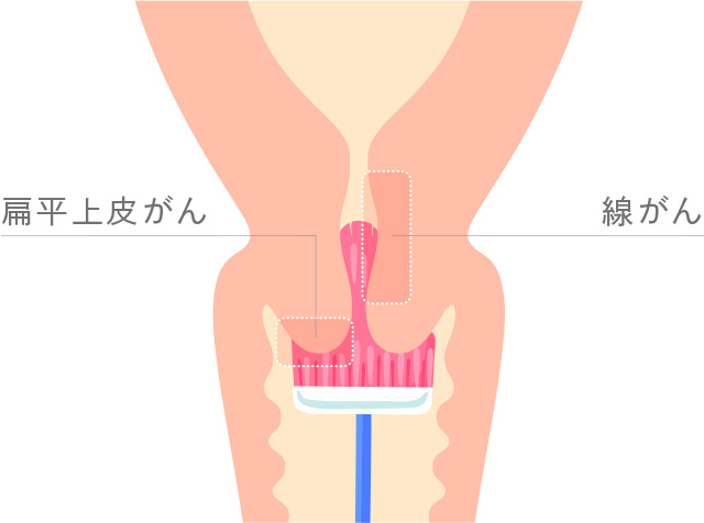 子宮頸がん検診